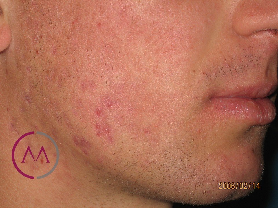 After image