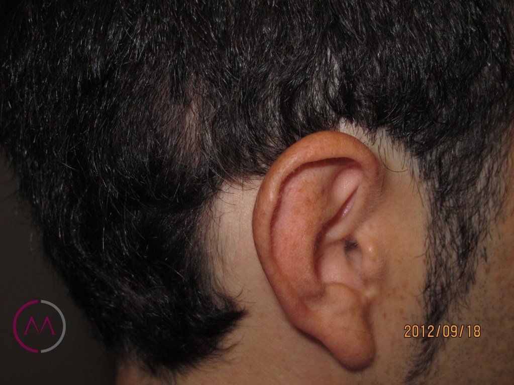 After image
