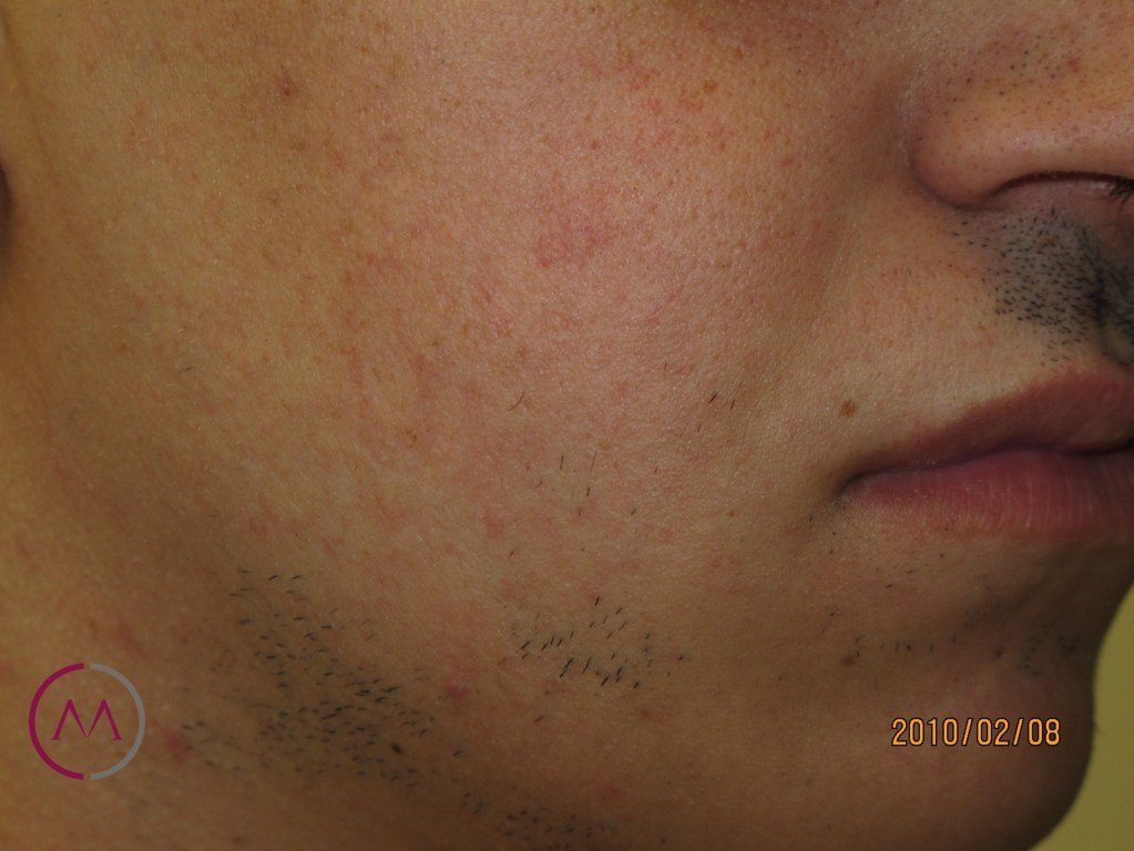 Before image