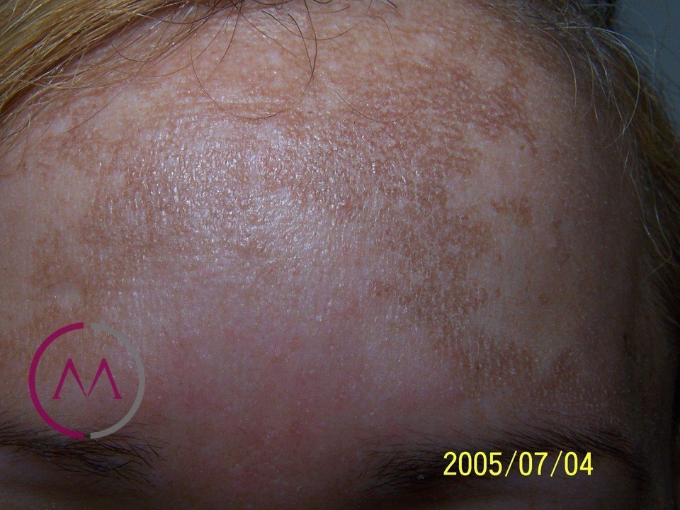 Before image