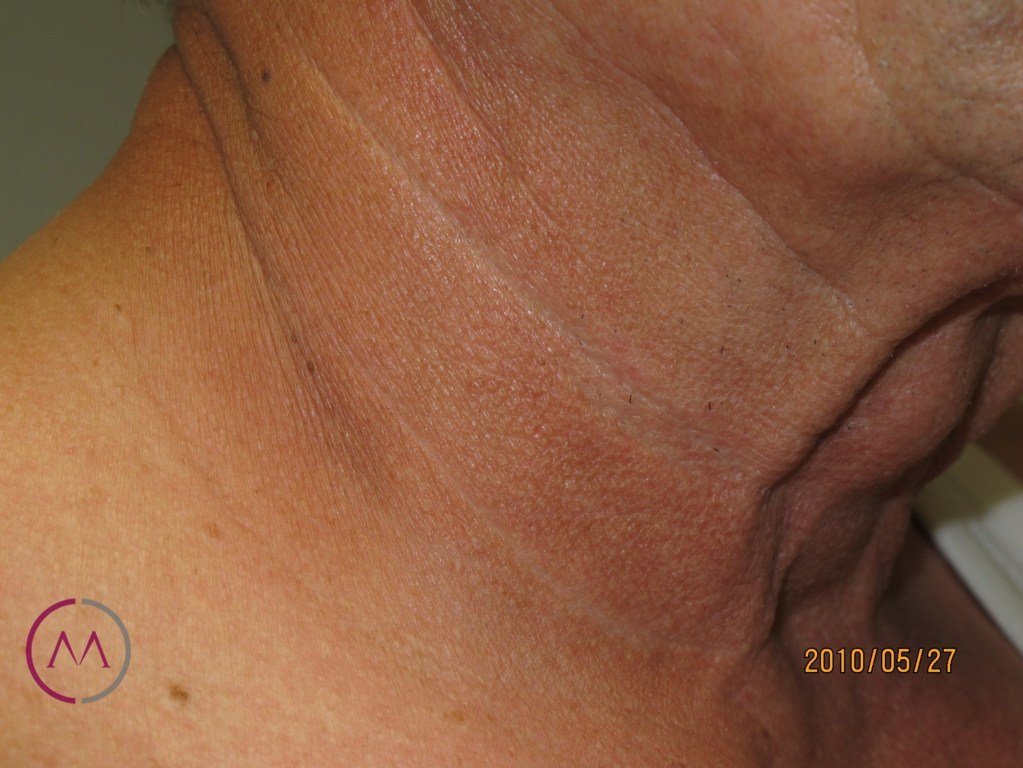 After image