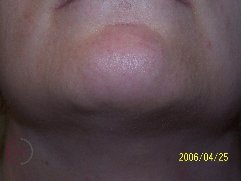 After image