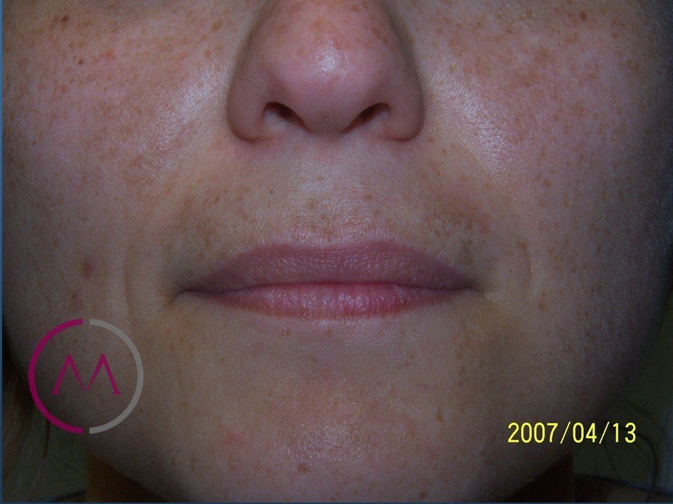 Before image