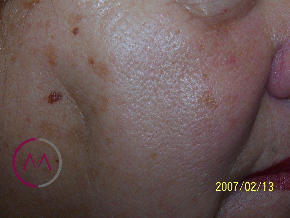 Before image