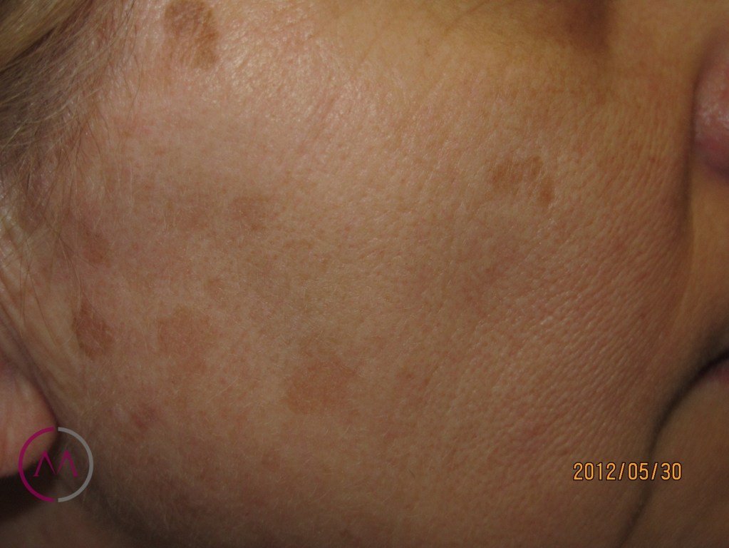 Before image
