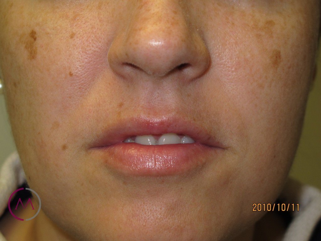 Before image