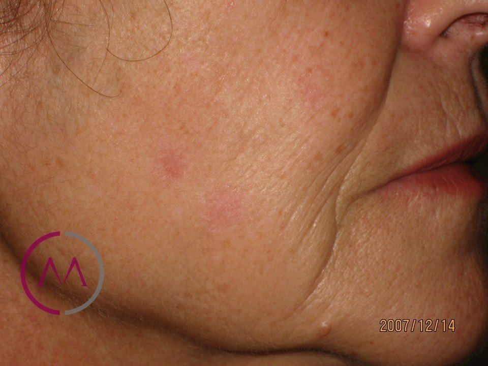 After image