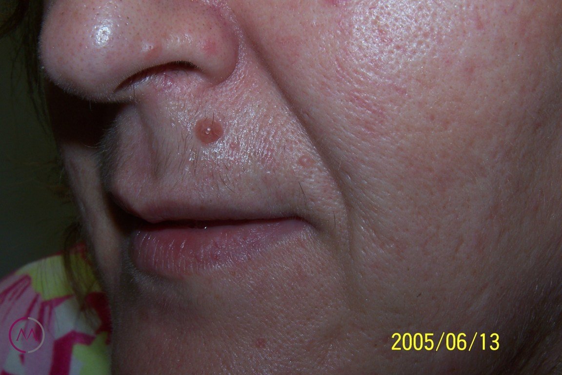 Before image